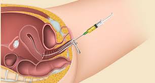 Frozen Embryo Transfer (FET)